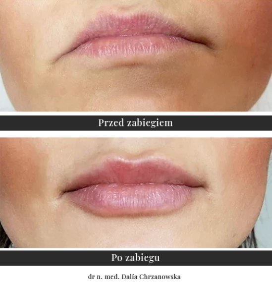 Lips modelling with hyaluronic acid