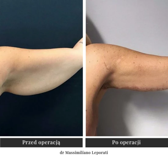 Plastic surgery of arms
