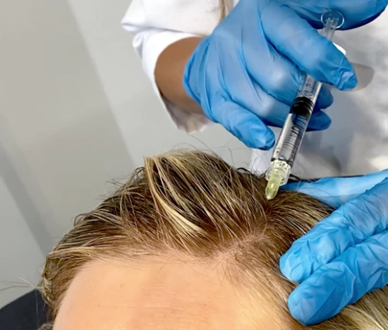 Mesotherapy - Peptide hair therapy