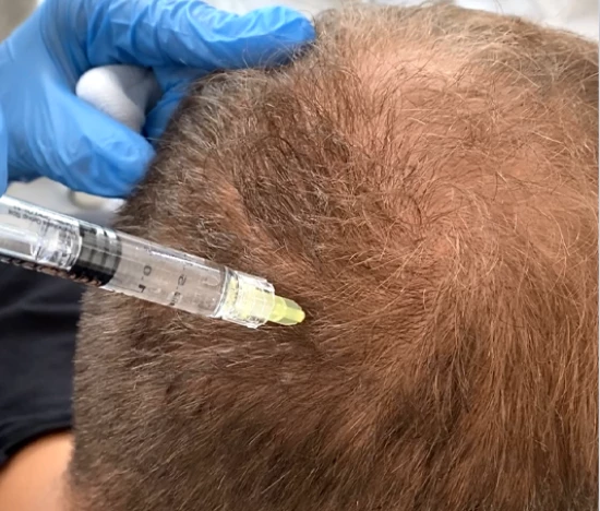 Treatment of androgenetic alopecia