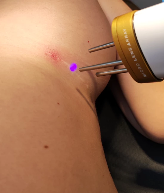 Scar laser therapy
