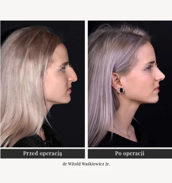 Corrective plastic surgery of the external nose and nasal septum