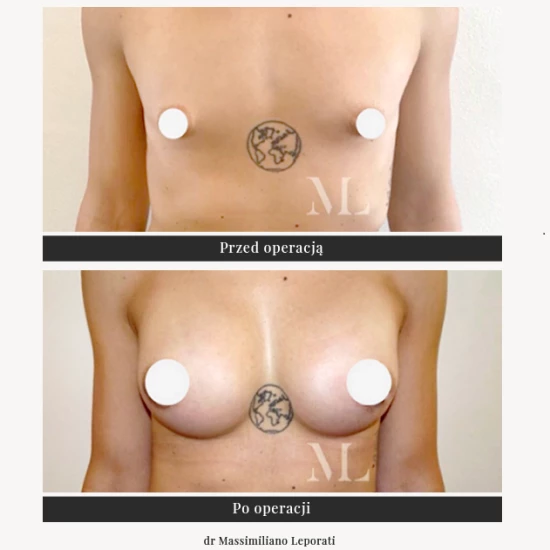 Breast augmentation with implants