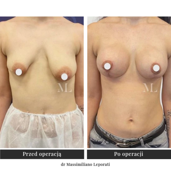Breasts symmetrisation
